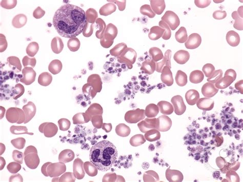 Essential thrombocythemia